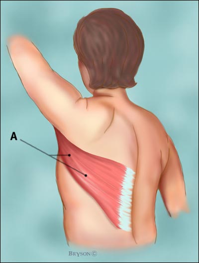latissimus_dorsi_flap1[2]_tcm8-79047